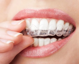 closeup of fingers placing upper clear aligner on teeth