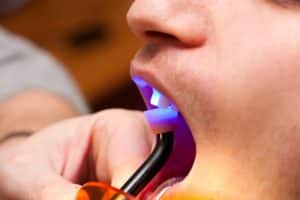 A dentist using a blue light to set cosmetic bonding material in a patient's mouth