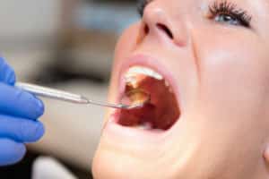 Close-up view of a patient having their mouth looked at by a dentist.