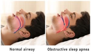 An example of a person with a normal airway open and an example next to it of what sleep apnea looks like. 