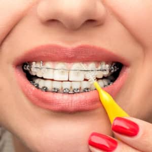 Close-up view of a woman cleaning her braces with a proxabrush.