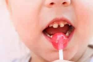 Close-up view of a child sucking on a lollipop. The child has tooth decay on all their teeth that is visible.