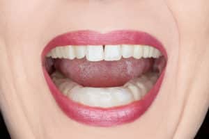 Close-up view of a woman's mouth as she wears a mouthguard for teeth grinding and TMJ problems.