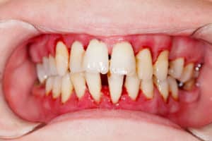 A view of the inside of a person's mouth who has gum disease. Their gums are red and the teeth have decay and recession.