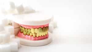 A model of the teeth where the teeth have gone yellow and the model is surrounded by sugar.