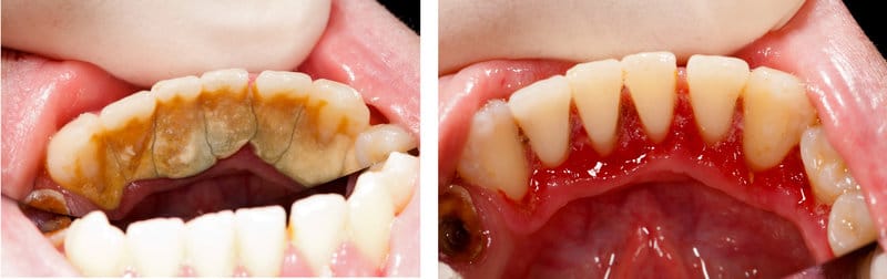 A patient's teeth covered in tartar and plaque in the left image and the restored smile in the right image that has received extensive dental work.