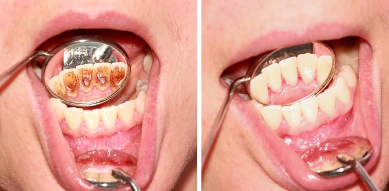 A close-up view of a patient's mouth that has plaque and lots of tartar on the back of their teeth. The "after" image is on the right showing what the smile looks like after dental treatment.