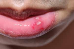 A close-up view of canker sores in a boy's mouth.