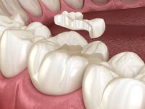 A digital rendition of the teeth that shows a layer of dental sealants on top of the teeth. 