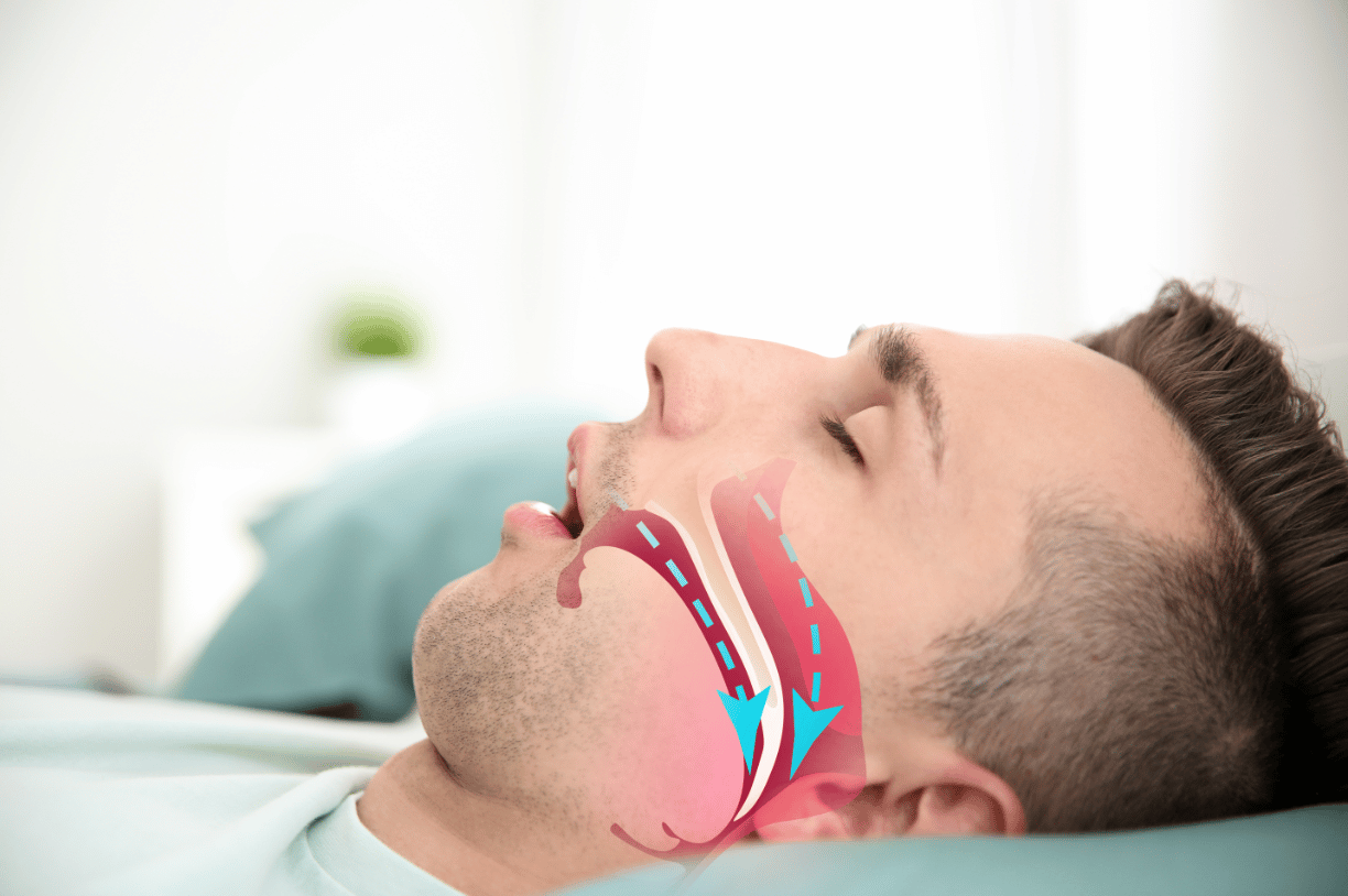 How Safe Is Obstructive Sleep Apnea? Fitness Omni