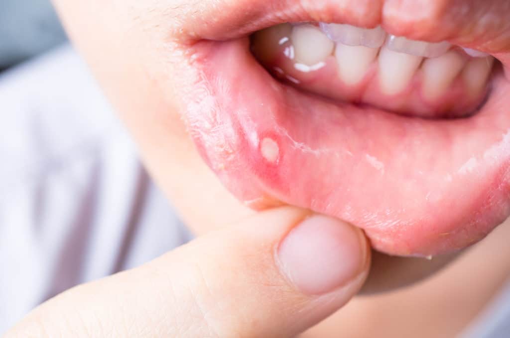 What To Do When Canker Sores Strike Boulder Dentist Family Cosmetic Dentistry Dr Ania 