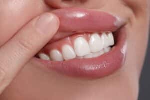 Woman after gum recession treatment in Boulder, CO