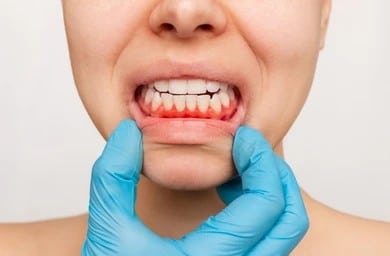 A close-up shot of a patient with gum recession 